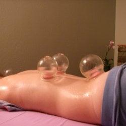 Cupping for the a sore back