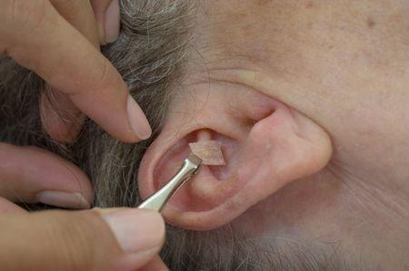 Auricular (Ear) Seeds