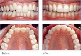 Did you have braces as a child or always want to beautify your smile?  Invisalign or invisible braces may be an option.