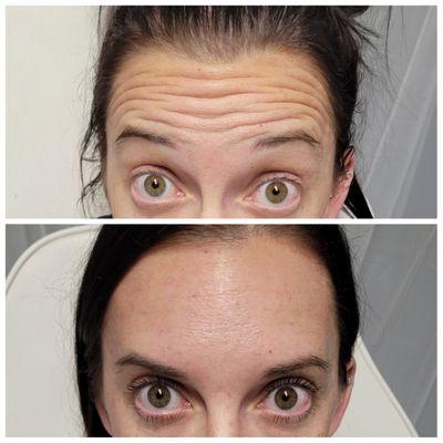 Before and after anti-wrinkle injections with botox!