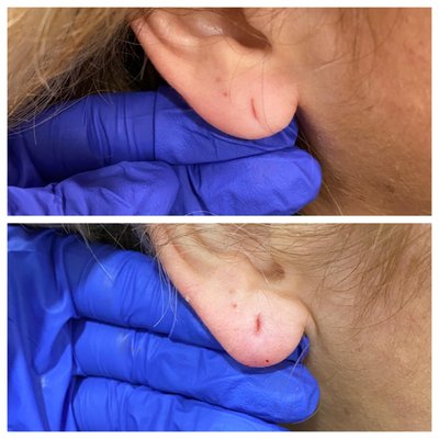 Ear Lobe Filler