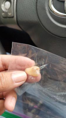 Wisdom tooth