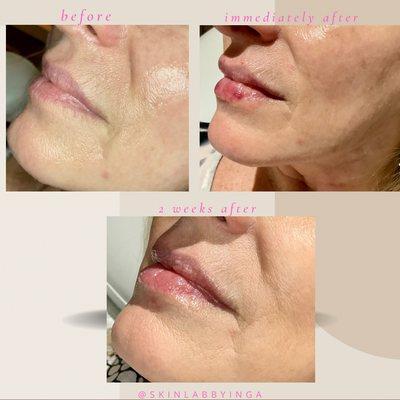 Lippies - Juvederm Volbella