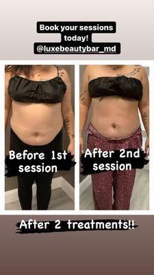 Body contouring session - after 2 sessions!