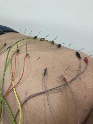 Electronic needles