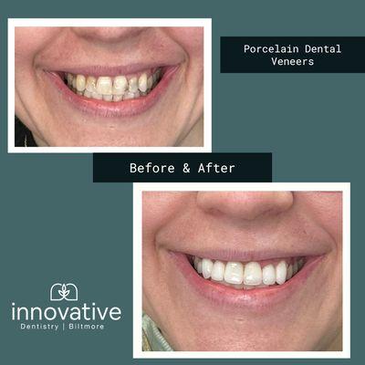 When cavities are impacting one's self esteem, consider porcelain dental veneers at Innovative Dentistry Biltmore