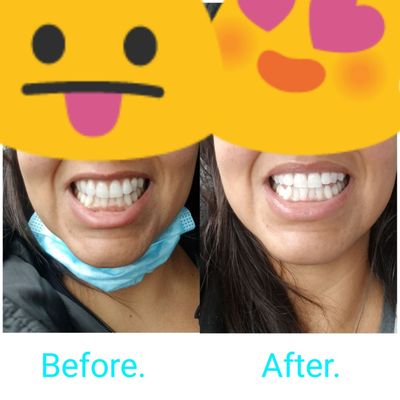 Exact same lighting before and after Zoom Whitening. They made sure i was comfortable the entire time.