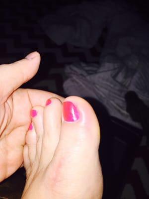 How my toes looked 24 hours after my pedicure. You can see the infection around the inner part of toenail!