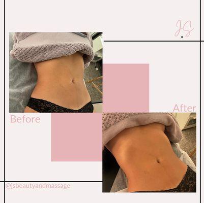 Before and after (lymphatic drainage)