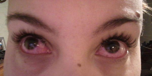 This is not an allergic reaction this is what a severe eye infection looks like