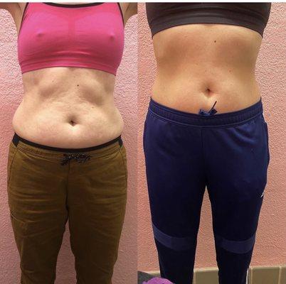 lipo cavitation +rf skin tightening