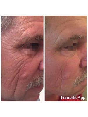 Reduction in lines and wrinkles using the Venus Viva , and Rezenerate