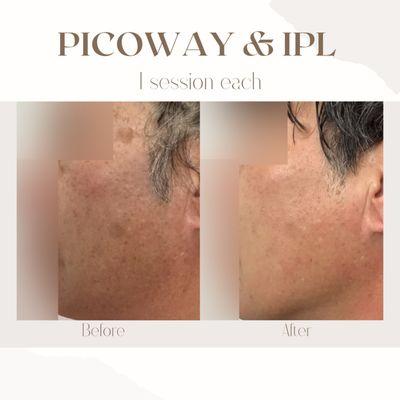 Real client at Polaris Aesthetics. After one session of picoway toning laser and IPL