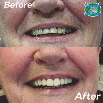 Dental crowns done by Dr Adam Burnett transformed this patient's smile!