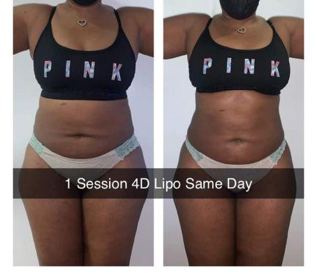 Before and after pics of 1 session of body contouring