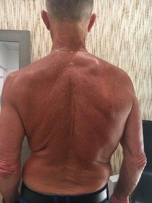 My upper back and shoulders AFTER working with Dr. Salles