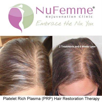 Platelet Rich Plasma (PRP) Hair Restoration for Women at NuFemme Rejuvenation Clinici -  Milwaukee, WI