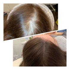 Scalp Micropigmentation