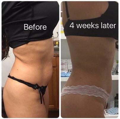 body contouring