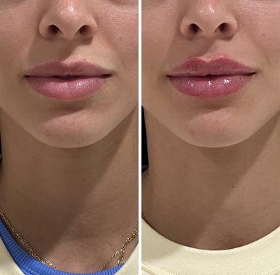 Lip Filler