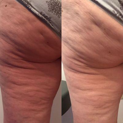 Cellulite treatment! Just after 1 treatment!!!