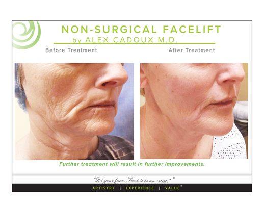 Gradual, Natrual, Long-Lasting Results! Stunning work by Dr.Cadoux.