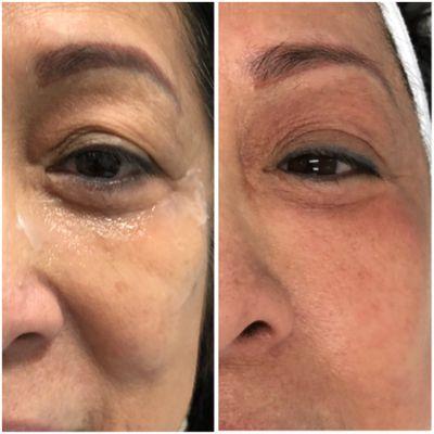 Upper eyelids lifts after 2 treatments.