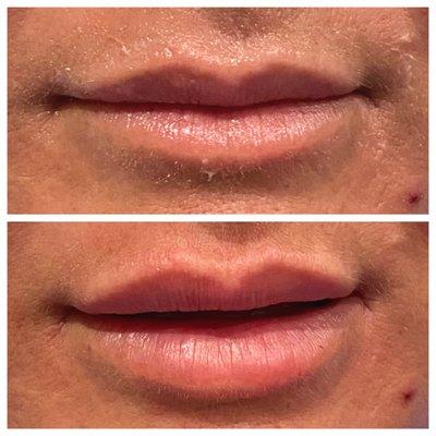 Volbella 0.55 lip filler (before and immediately after)