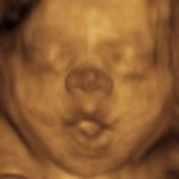 3D ultrasound at 27 weeks.