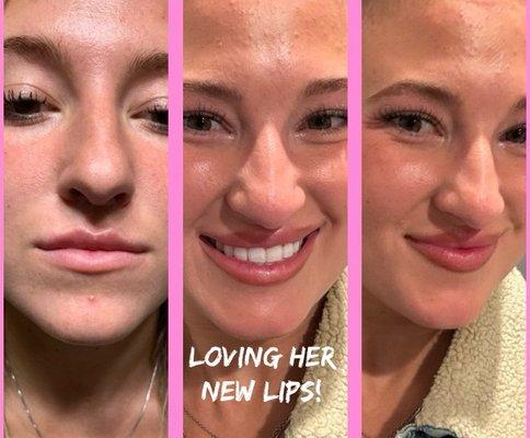 Lip Augmentation- beautiful & natural look