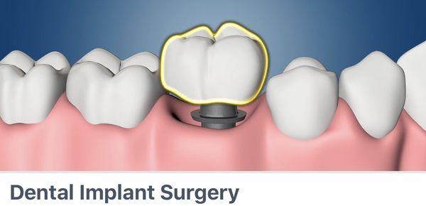 https://myoms.org/procedures/does-insurance-cover-dental-implants