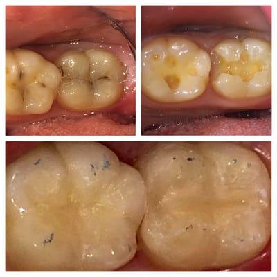 tooth colored fillings replacing decayed teeth