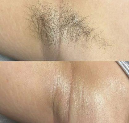 Quick underarm hair removal, 10 minute appointment