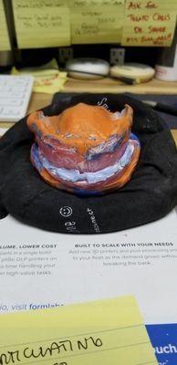 3D Denture First Step Scaning