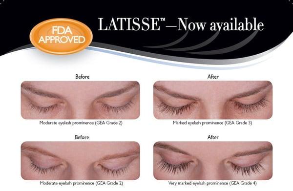 Latisse is now offered at Eyecare Essentials!