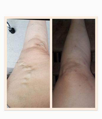 Before & After Varicose Vein removal