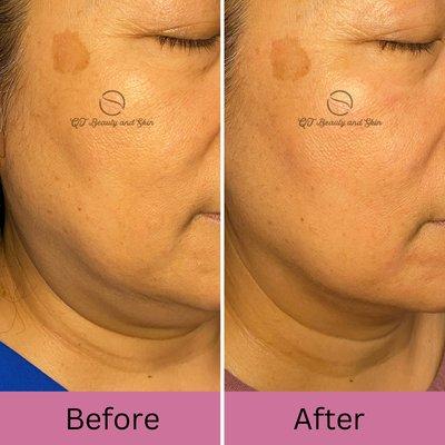 Lymphatic Facial for defined jawline.