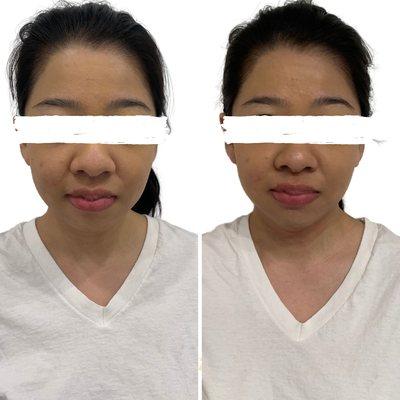 Chin and Jawline Slimming 1st Session Treatment