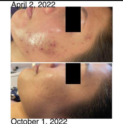 Before and After. Cleanse and repair treatment for acne and sensitive skin