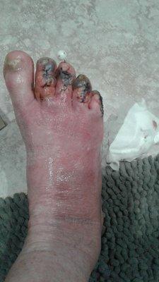 After Dr. Pirotta removed 3 pins, my toes were black, and I had to be admitted to a hospital for a severe bone and skin infection.