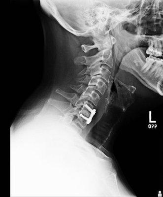 This is what can happen in a rear-end collision. That's my X-ray from 2006.