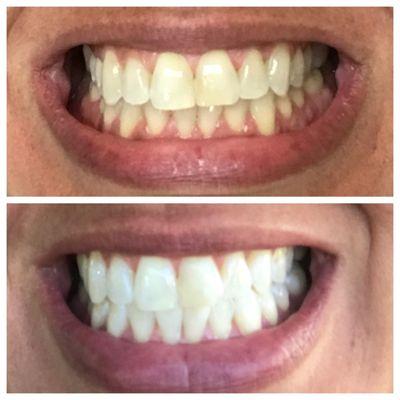 Boost whitening results after only one session!