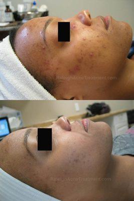 Acne Treatment results at Luminosity Acne Skincare.