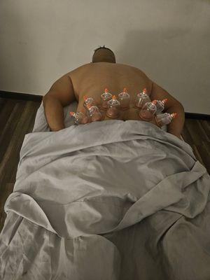 Cupping therapy ‍