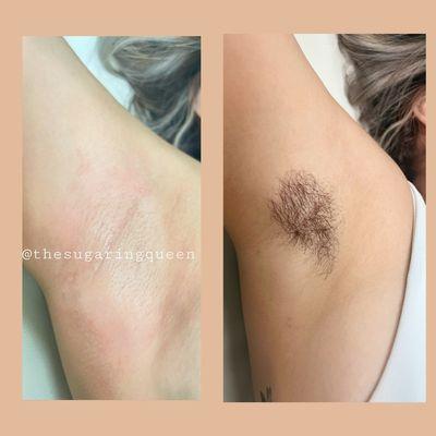 Underarm hair removal