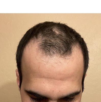 Before the hair transplant