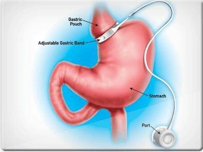 Laparoscopic Lap Band