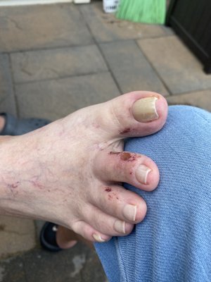 This is my husbands foot after his pedicure on July 13th