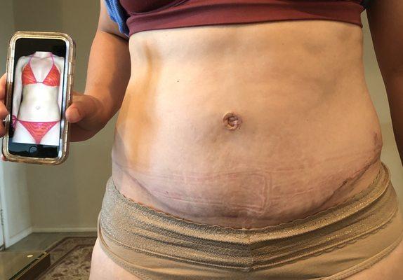 Post op holding phone of regular body pre baby