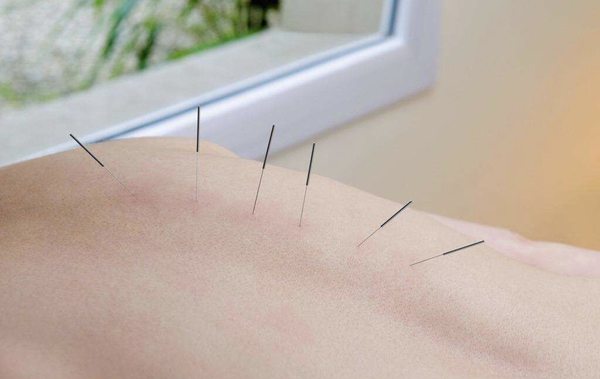 Acupuncture helps to alleviate pain.